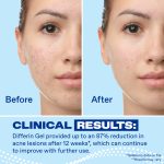 Differin Acne Treatment Gel with 0.1% Adapalene, Prescription-Strength Retinoid Clears & Prevents Acne, Fragrance-Free, 1.6 oz (45g) Pump ​ - Image 4